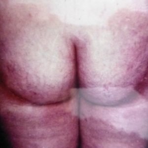 cicatrices de la fesse après lifting