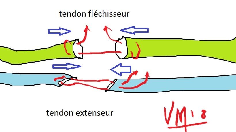 réparation de plaie des tendons