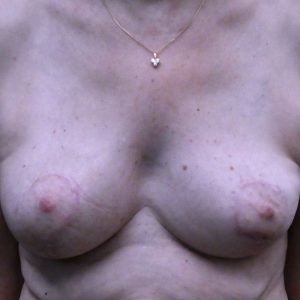 résultat de réduction mammaire après 1 an, technique vladimir mitz