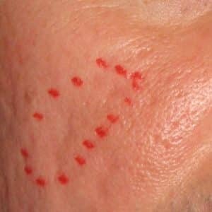 cicatrices d"acné avant