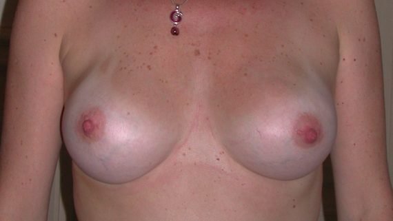 après augmentation mammaires chirurgie esthétique